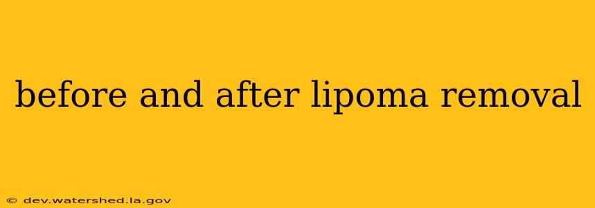 before and after lipoma removal