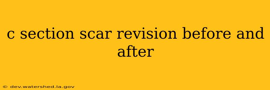 c section scar revision before and after