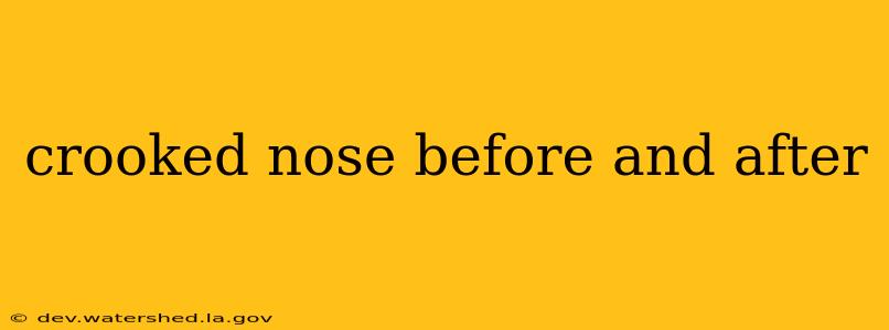 crooked nose before and after