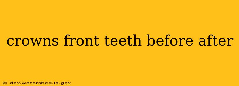 crowns front teeth before after