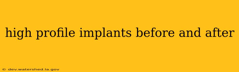 high profile implants before and after