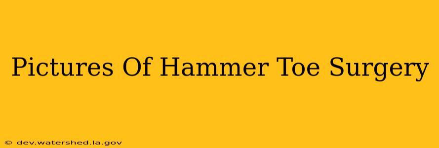 pictures of hammer toe surgery