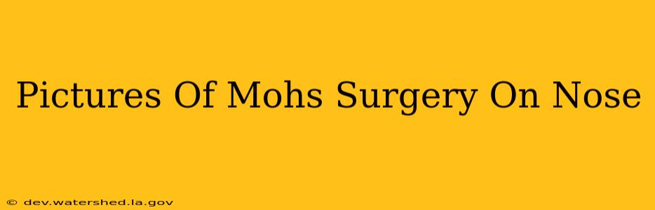 pictures of mohs surgery on nose