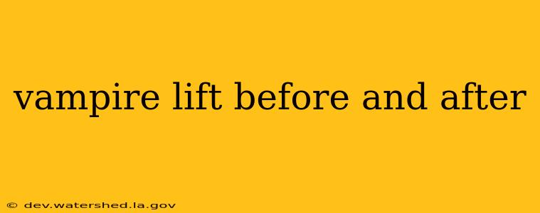 vampire lift before and after