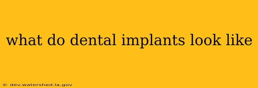 what do dental implants look like